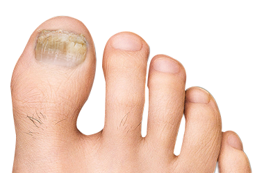 Foot with toe fungus