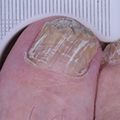 Ongles effrités
