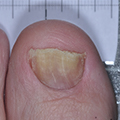 Ongles effrités