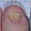 Toe with nail crumbling