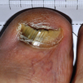 Ongles effrités