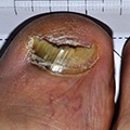 Toe with nail crumbling