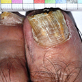 Ongles effrités