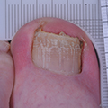 Ongles effrités