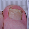 Toe with nail crumbling