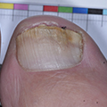 Ongles effrités