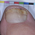 Toe with nail crumbling