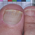 Ongles effrités